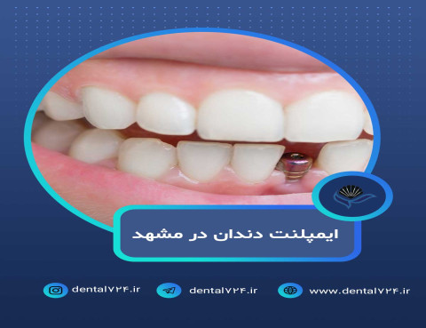 ایمپلنت دندان در مشهد با اقساط بلندمدت و شرایط ویژه